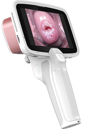 Dispositivo CerviCARE AI — colposcopio portátil con IA embebida
