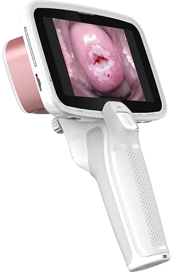 Dispositivo CerviCARE AI — colposcopio portátil con IA embebida